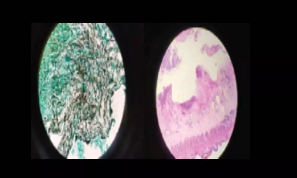 Rare ‘White Fungus’ affects patient’s gut