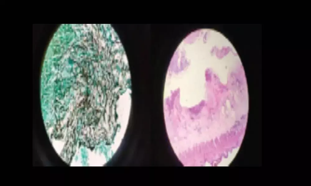 Rare ‘White Fungus’ affects patient’s gut