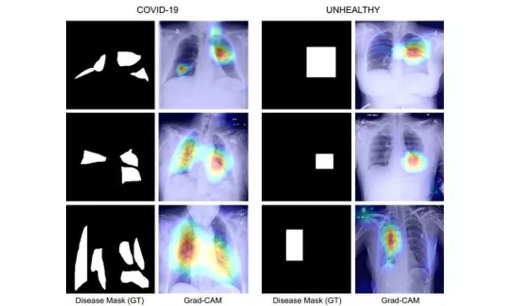 IIT Jodhpur team develops Covid diagnosis technique using chest X-Ray