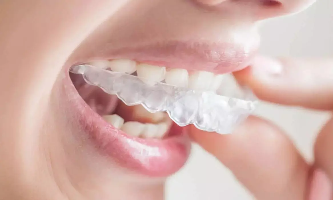 India’s clear aligners mkt to reach $500 mn by 2023