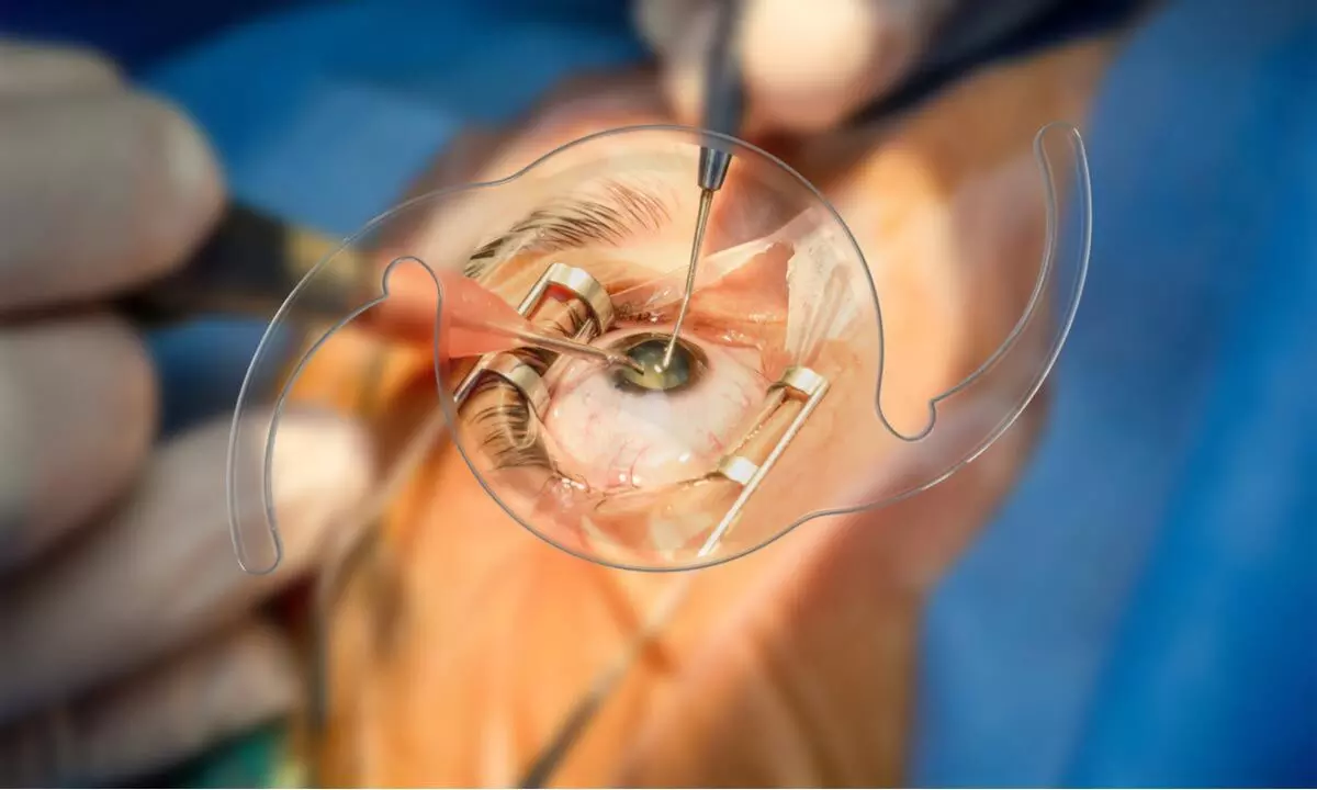 Rising cataract surgeries fuel artificial lens market growth