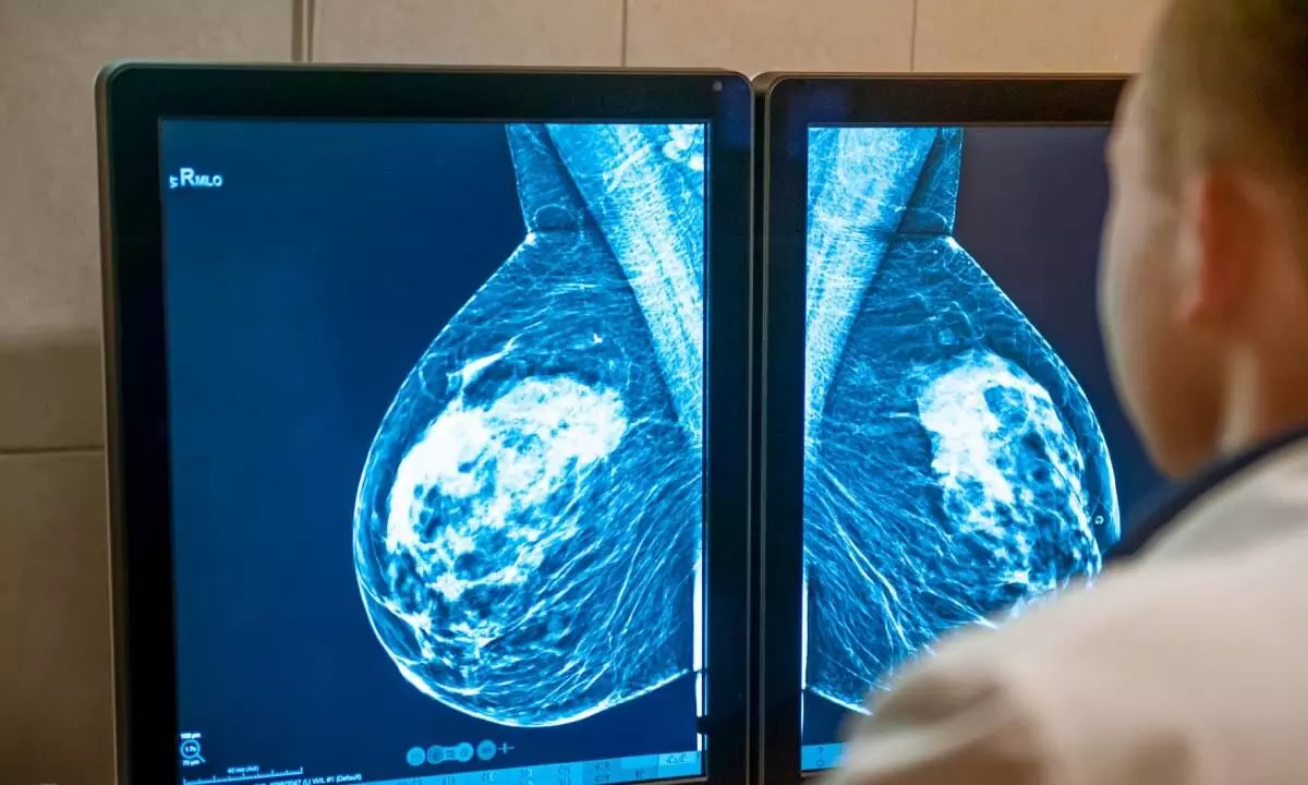AI help detects 20% more breast cancers, reduces workload by 44%
