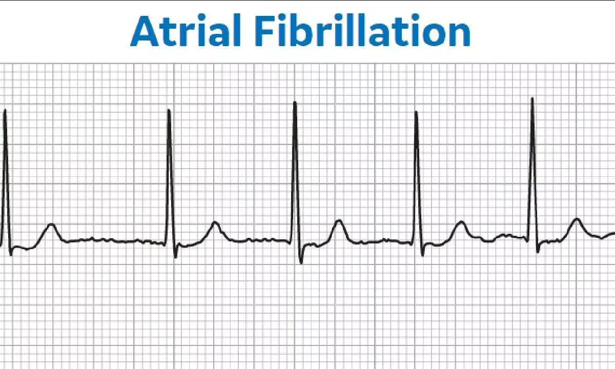 Researchers develop new tool to reduce stroke risk