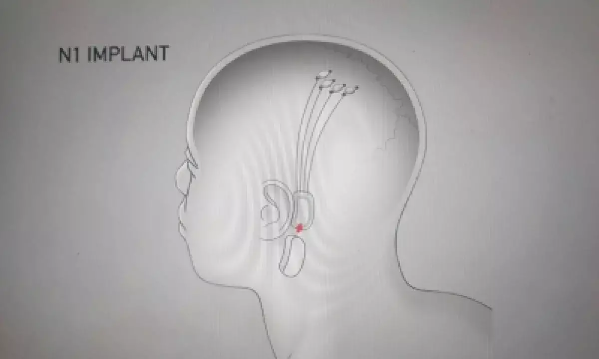 Musk’s Neuralink now recruiting for 1st human trial of its brain-computer interface