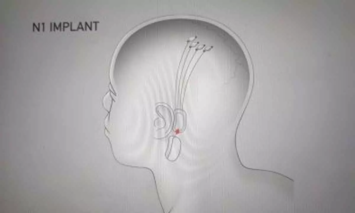 Neuralink to begin brain computer interface trials