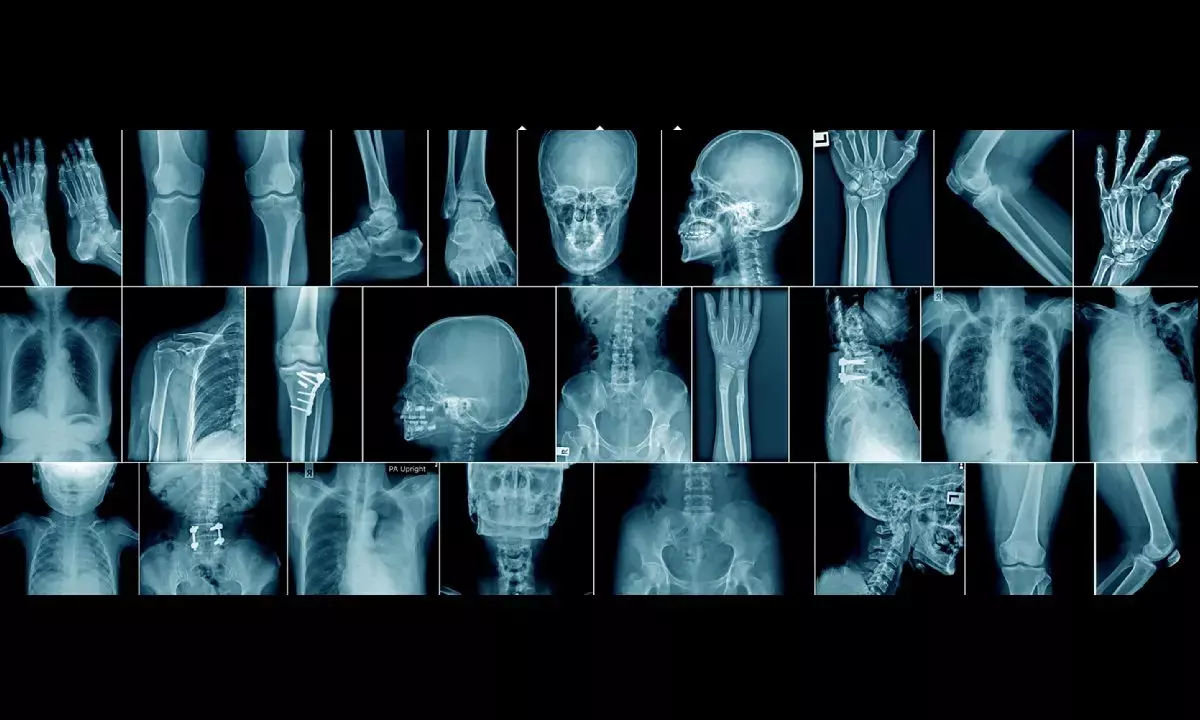 Exposure to PFAS may affect bone health in adolescents & young adults