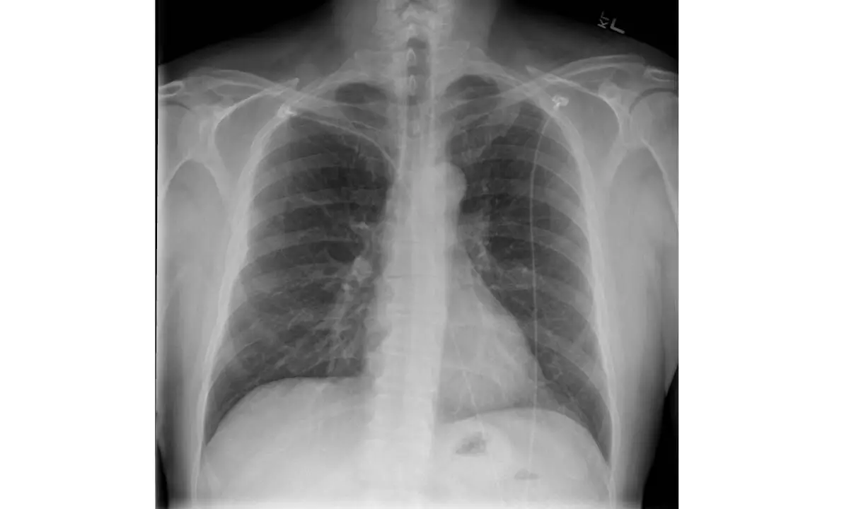 New AI tool can detect Covid infection from chest X-rays 98% accuracy