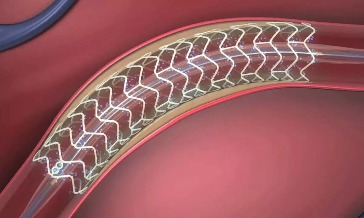 India’s coronary drug-eluting stents mkt to register 4% CAGR by 2033: Report