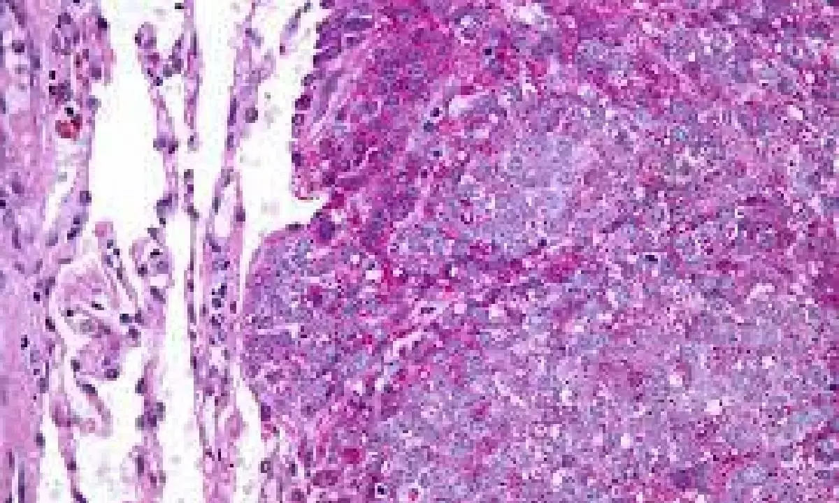 Mumbai docs successfully treat woman with rare Ewing’s sarcoma of breast