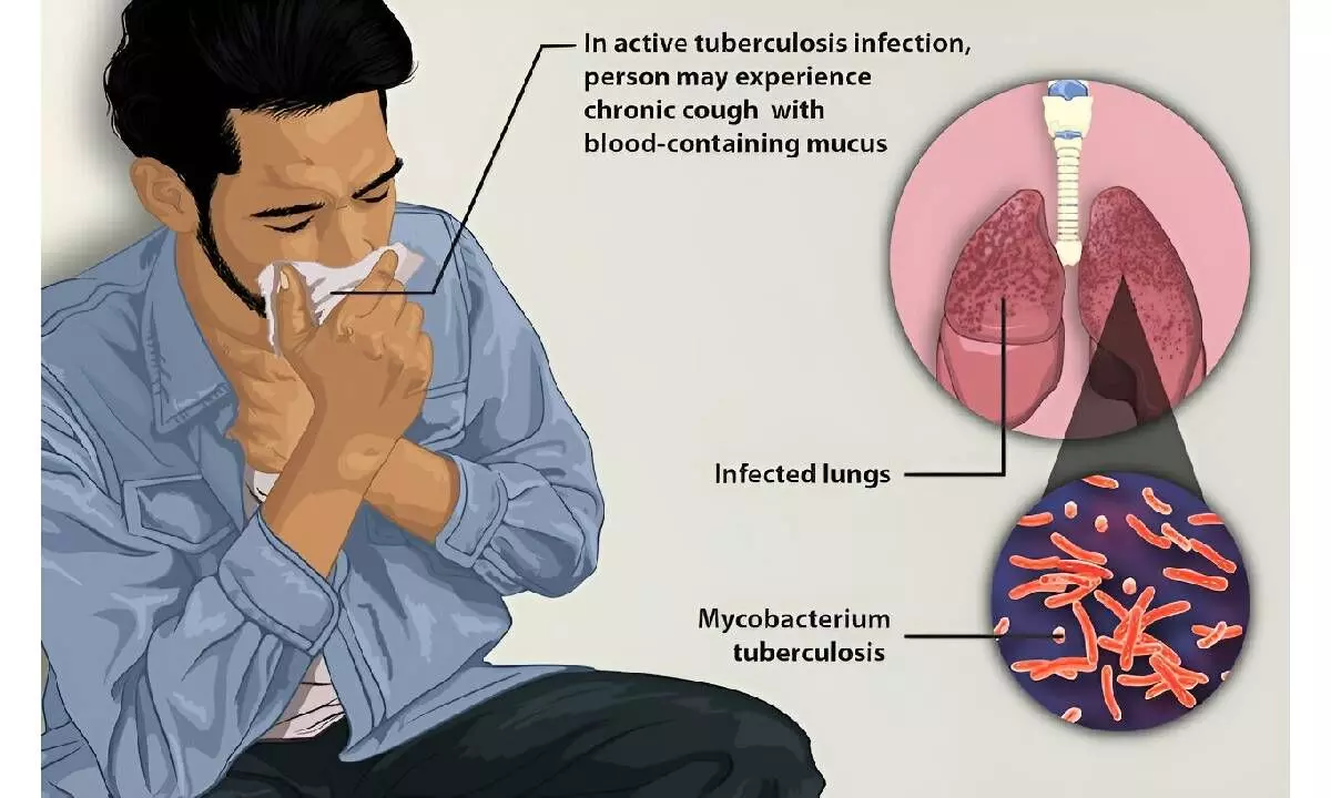 TB diagnosis must go beyond persistent cough: Lancet study