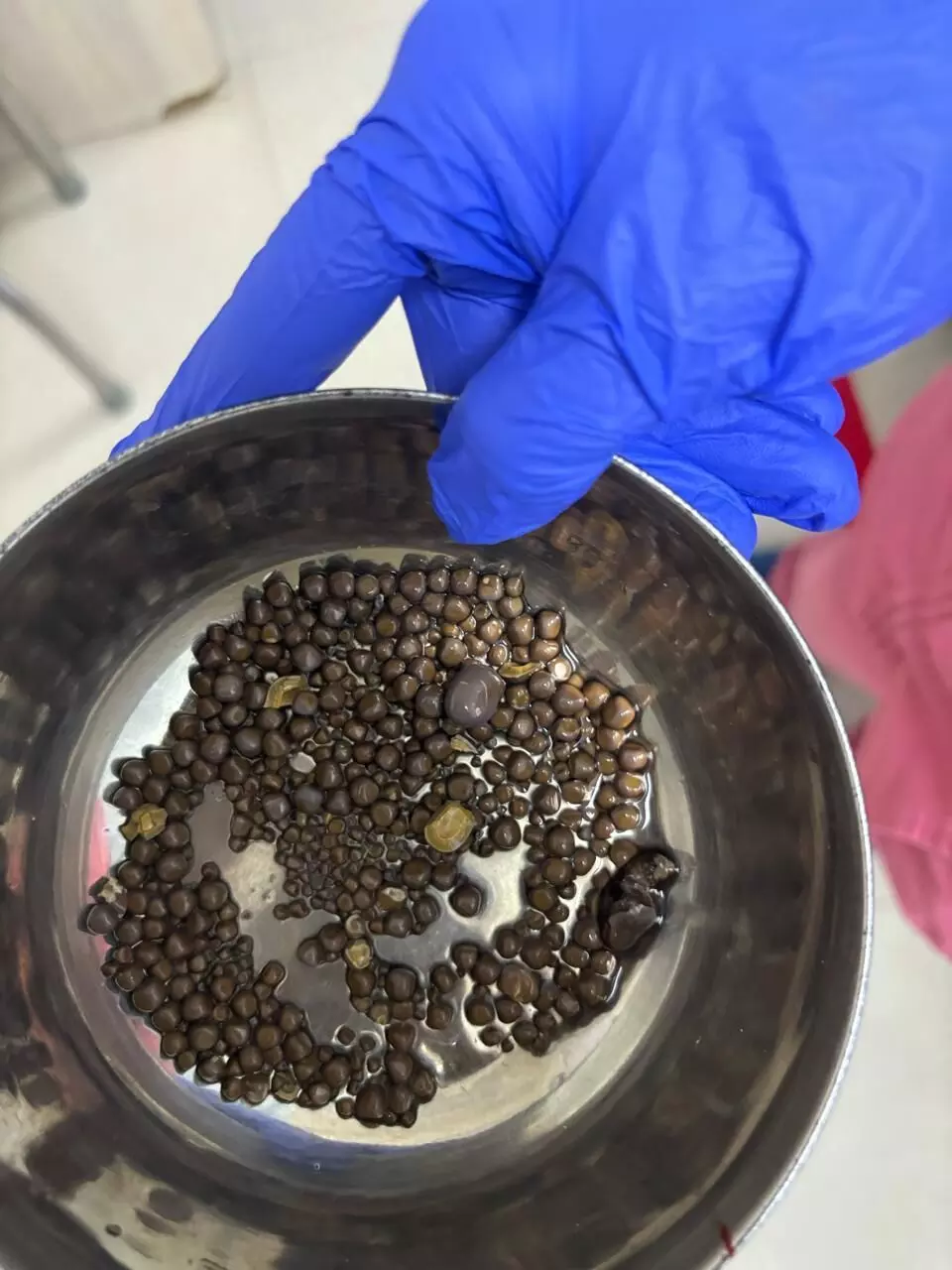 418 kidney stones removed from patient with 27% kidney function