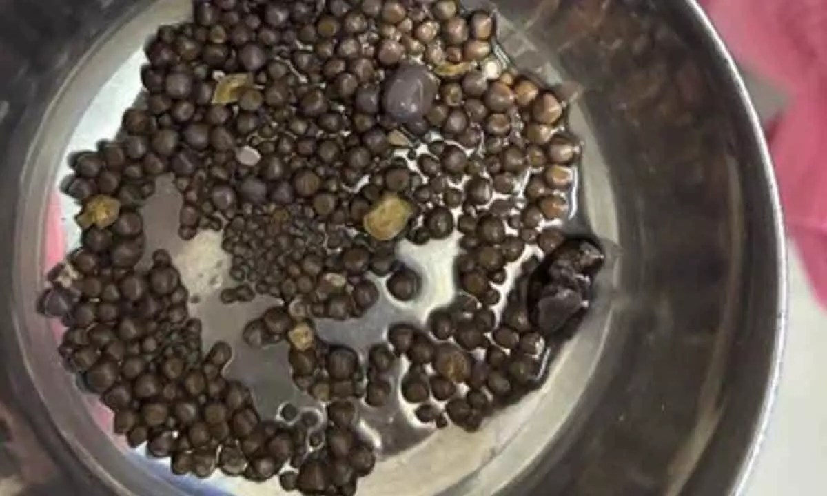 418 kidney stones removed from patient