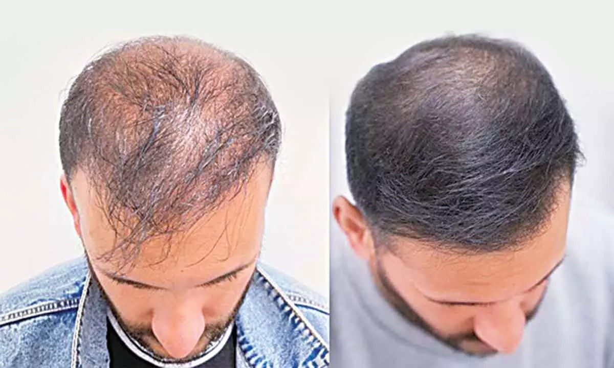 Treated on time, hair loss may not be as worrisome as feared