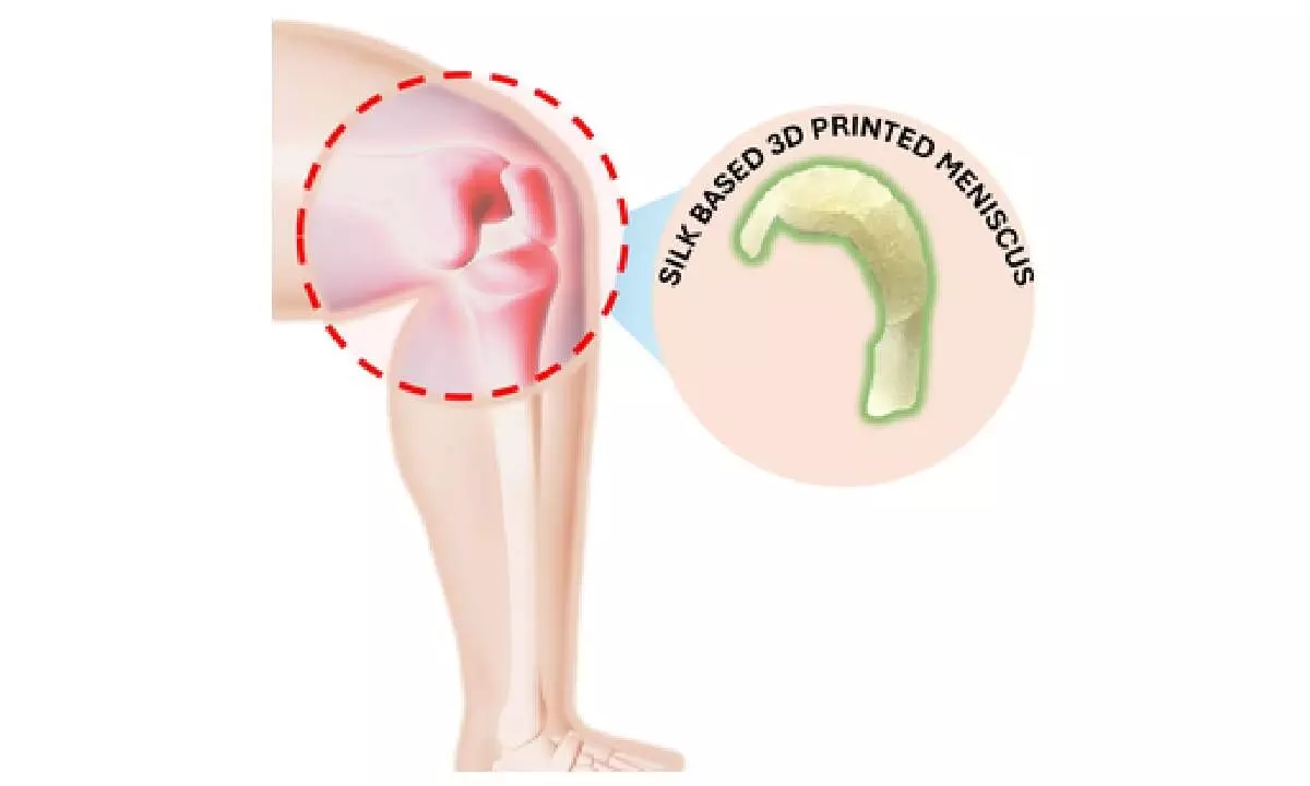 IIT Guwahati develops 3 ingenious therapies for knee meniscus tear