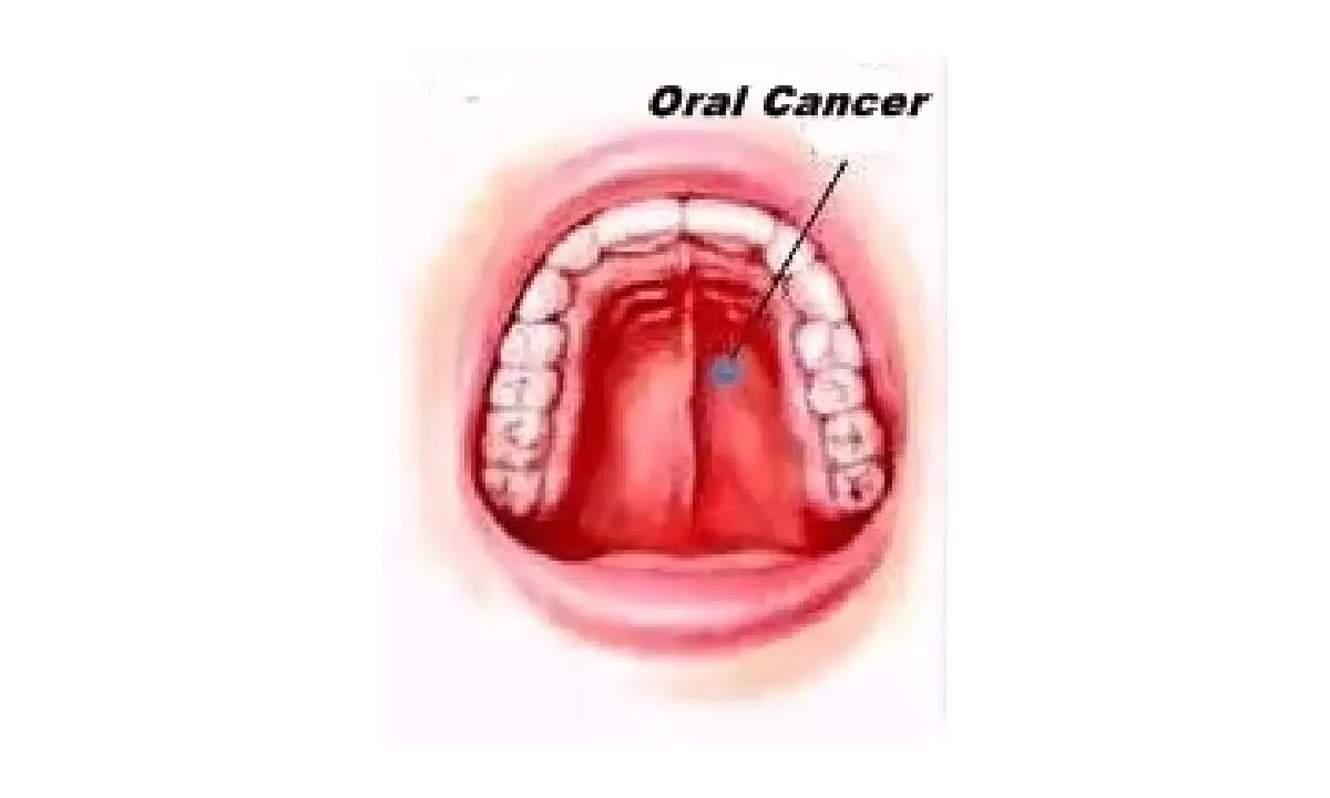 Why India is seeing a rise in oral cancer cases