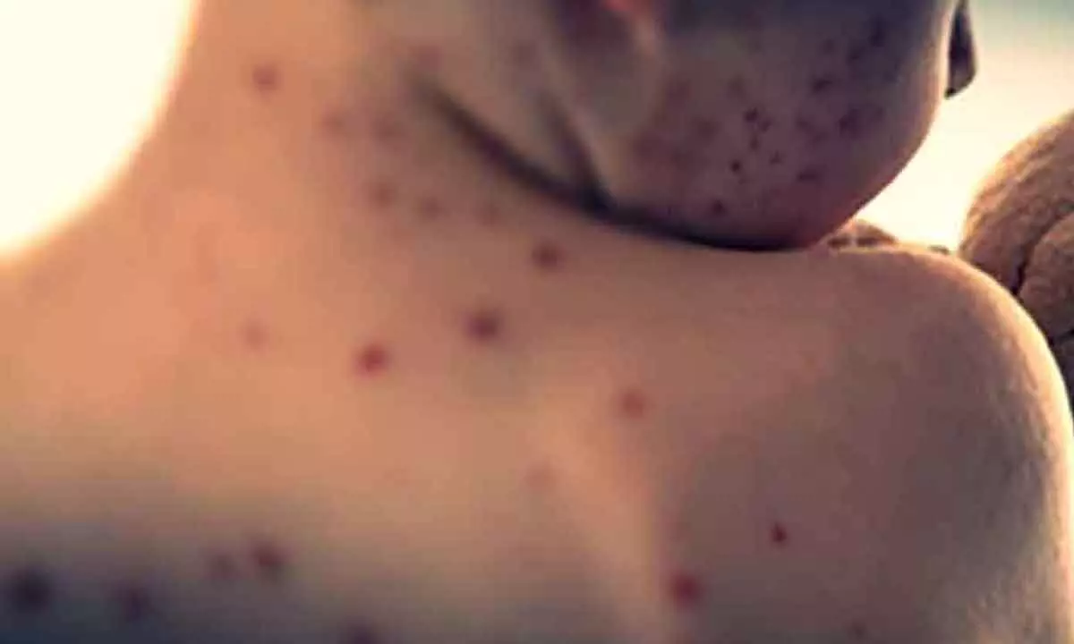 Global measles cases see 88% jump in 2023: WHO