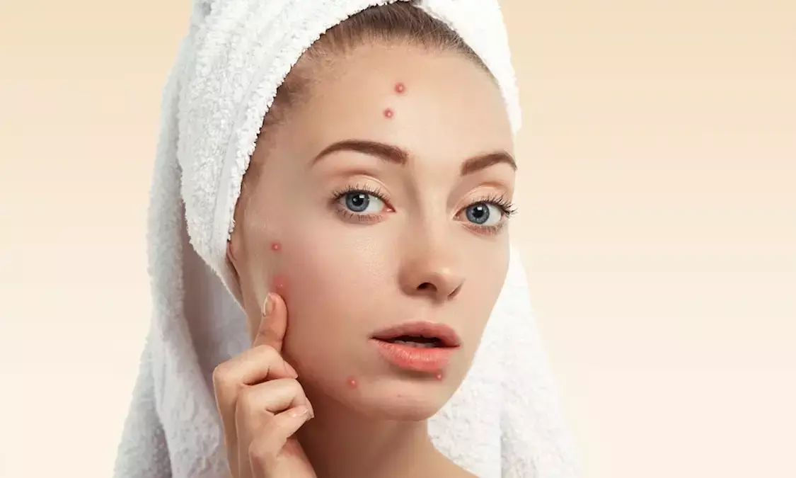 Are you dealing with acne? Learn how hydration can assist in clearing your skin.