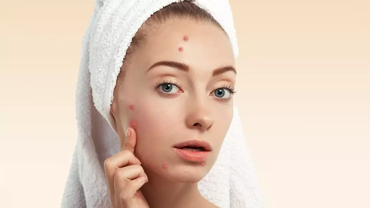 Are you dealing with acne? Learn how hydration can assist in clearing your skin. Are you dealing with acne? Learn how hydration can assist in clearing your skin.