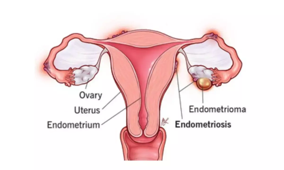 Swiss researchers develop a hydrogel implant to treat endometriosis