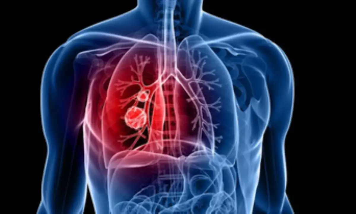 Lung cancer most common cancer can to spread to brain