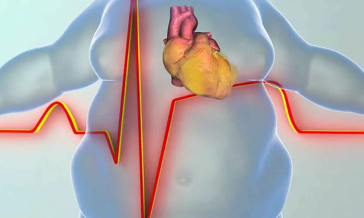 Study finds link between obesity, and heart failure
