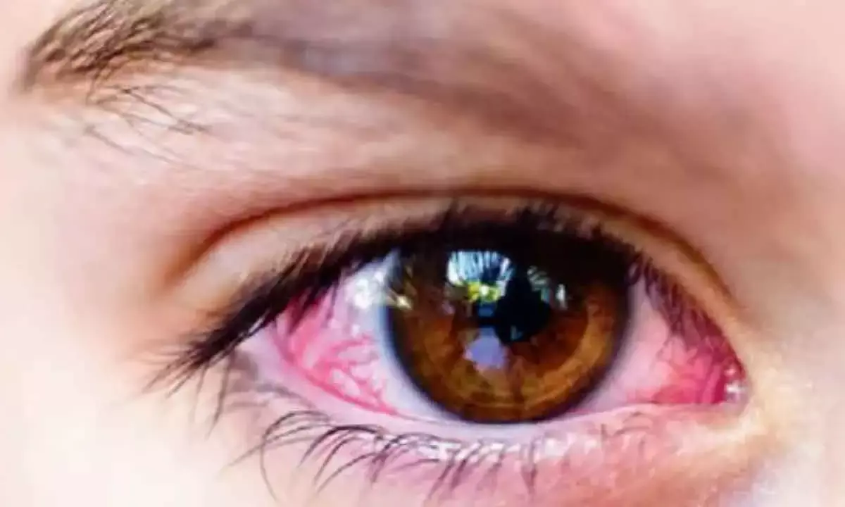 LVPEI doctors caution on ignoring conjunctivitis