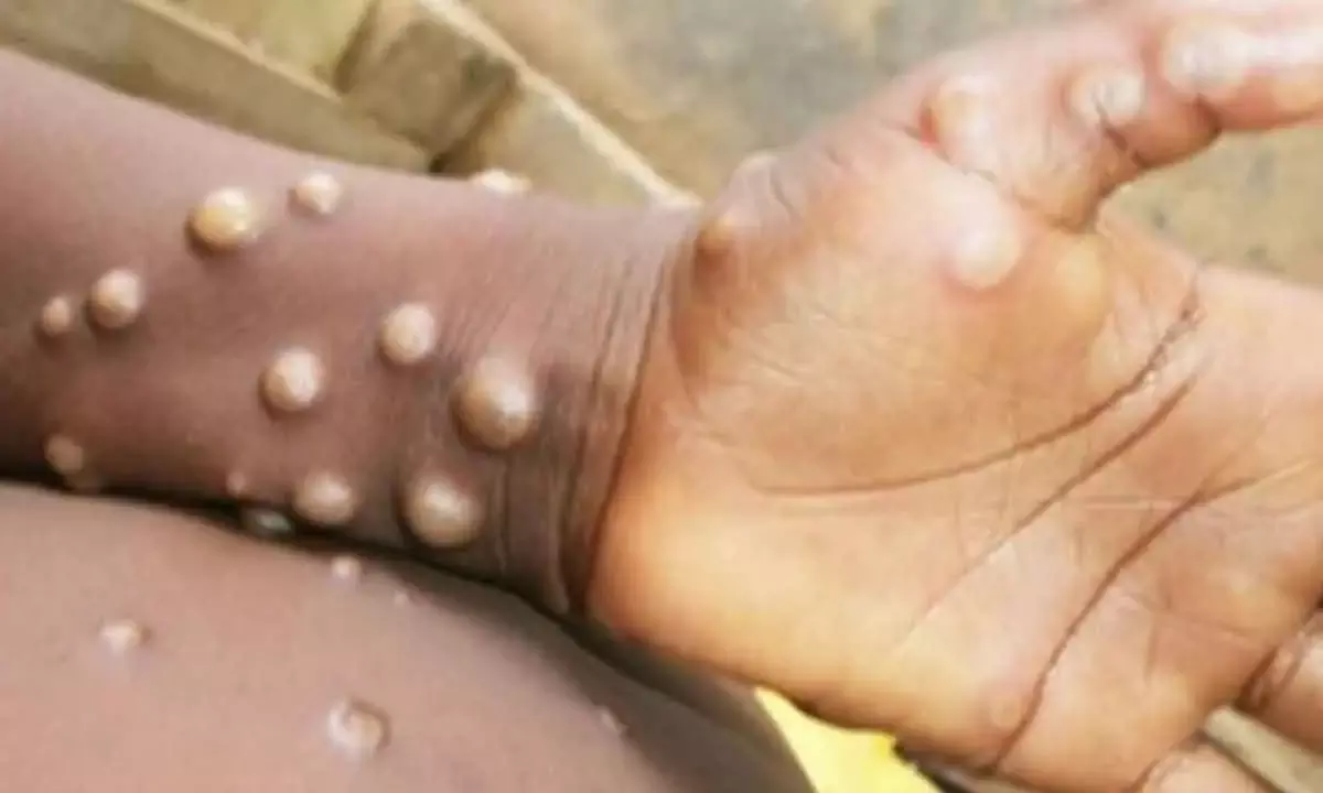 Mpox impacting a broader demographic: Lancet Report