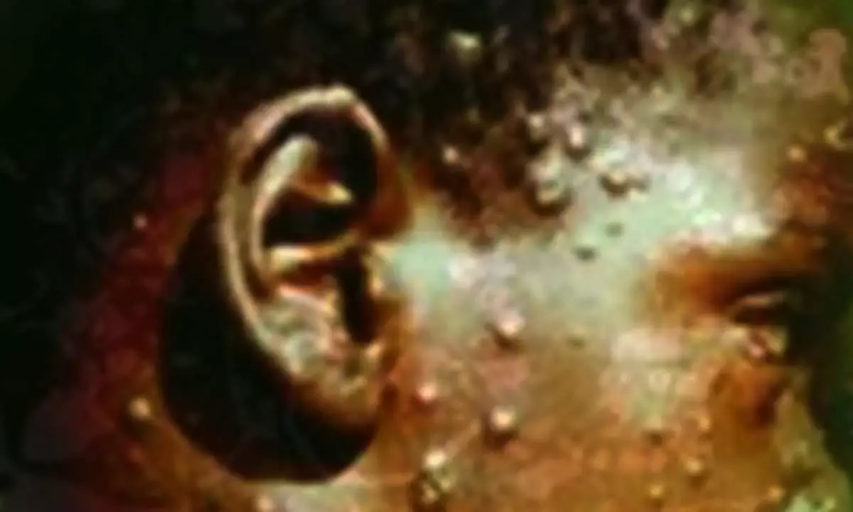 New Mpox strain poses notable risk to children