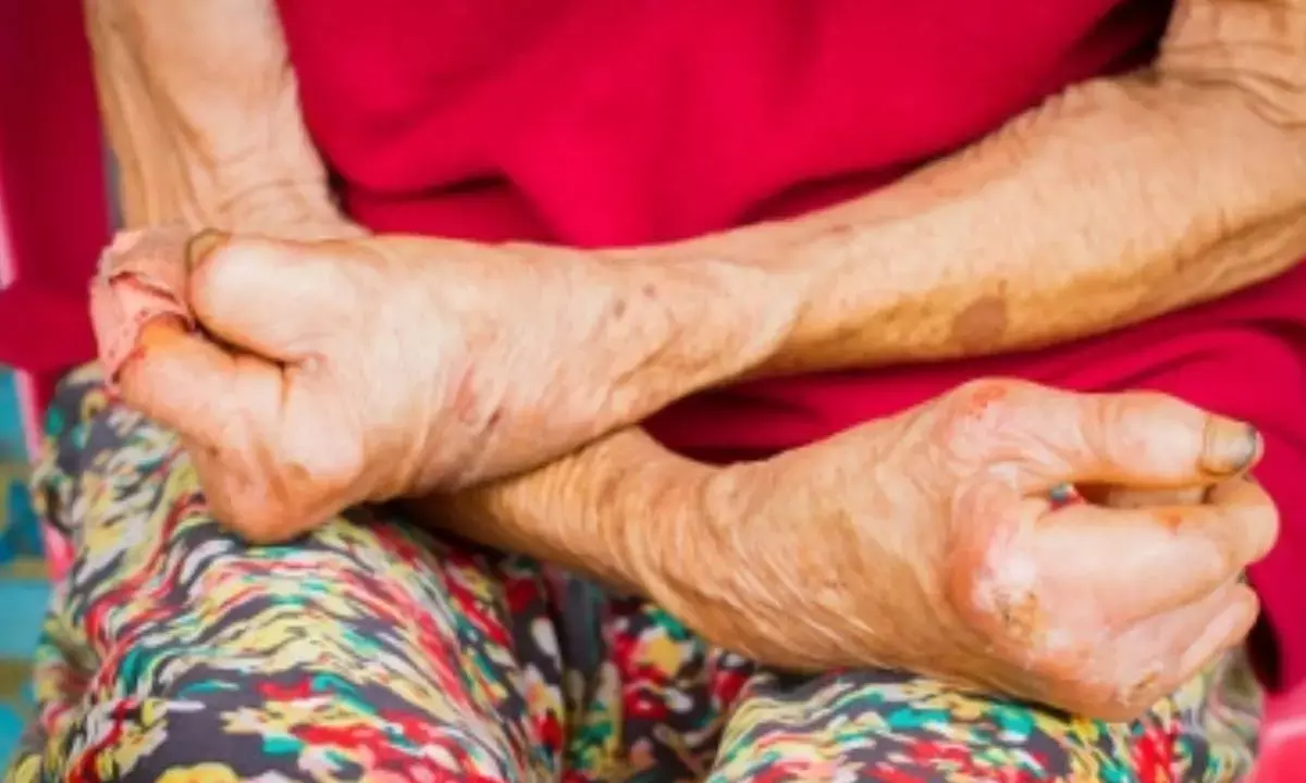 Jordan First Country To Eliminate Leprosy: WHO