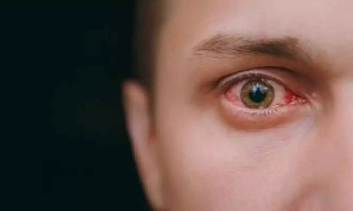 Antiviral Medication May Prevent Vision Damage Linked With Shingles