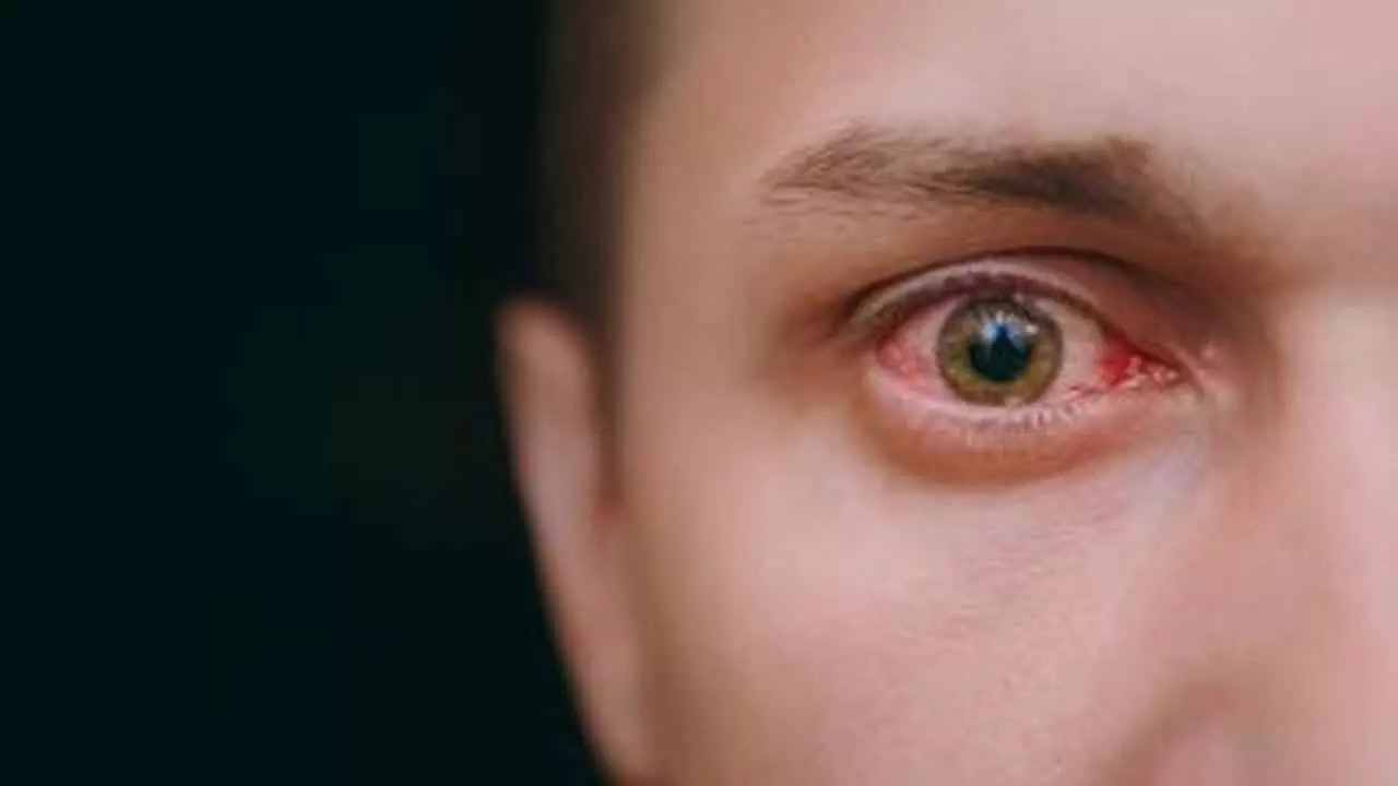 Antiviral Medication May Prevent Vision Damage Linked With Shingles Antiviral Medication May Prevent Vision Damage Linked With Shingles