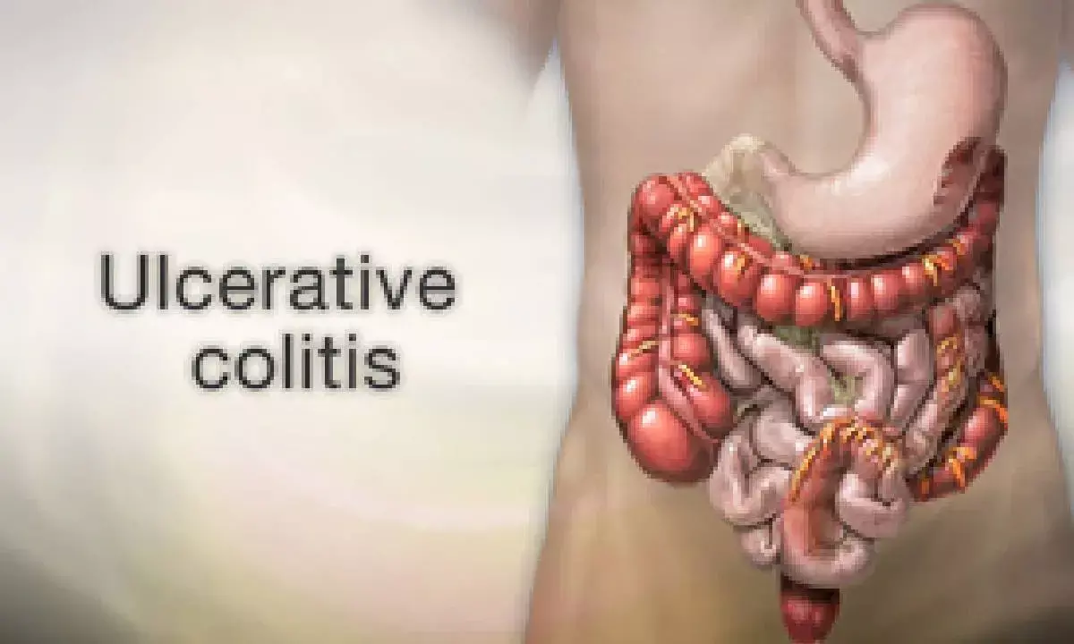 Scientists link colon cancer risk to specific gene in ulcerative colitis