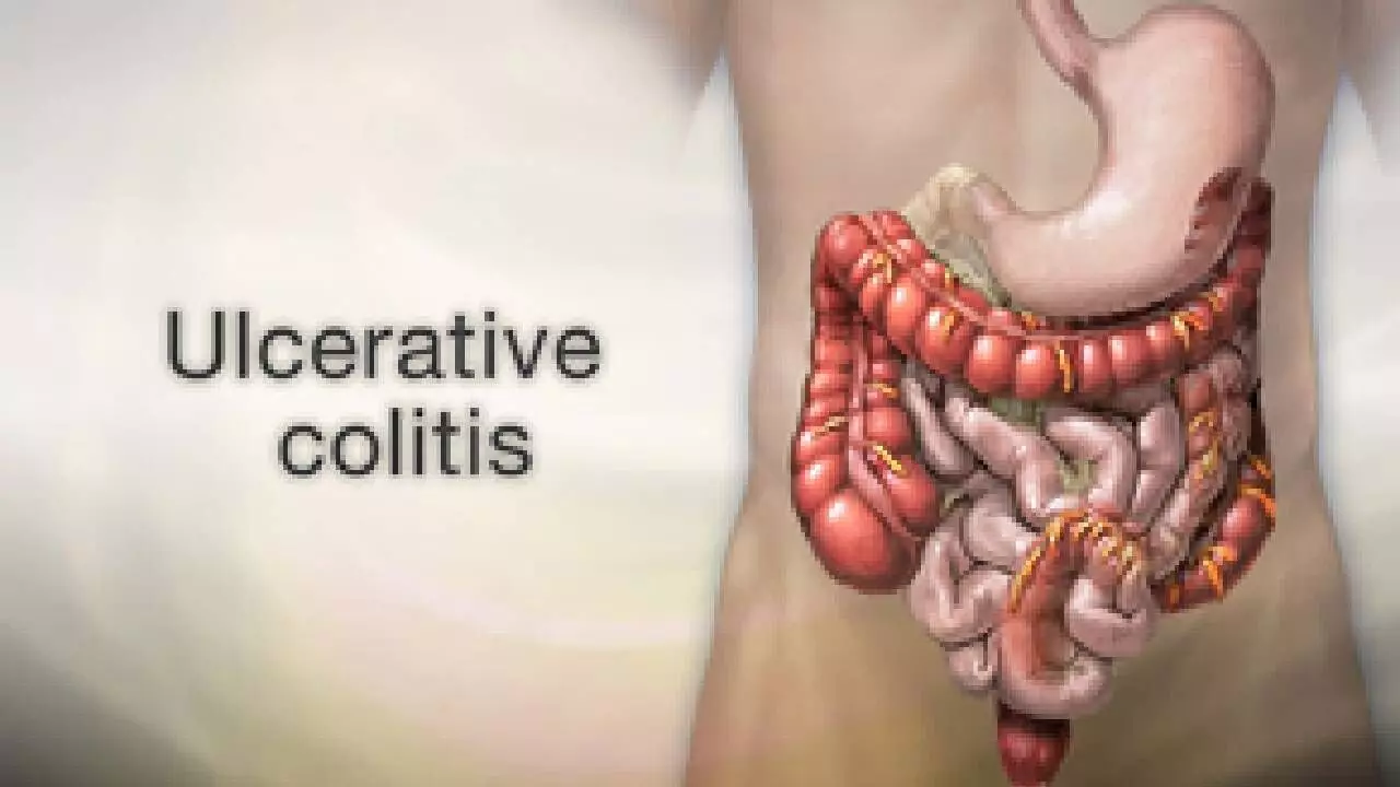 Scientists link colon cancer risk to specific gene in ulcerative colitis Scientists link colon cancer risk to specific gene in ulcerative colitis