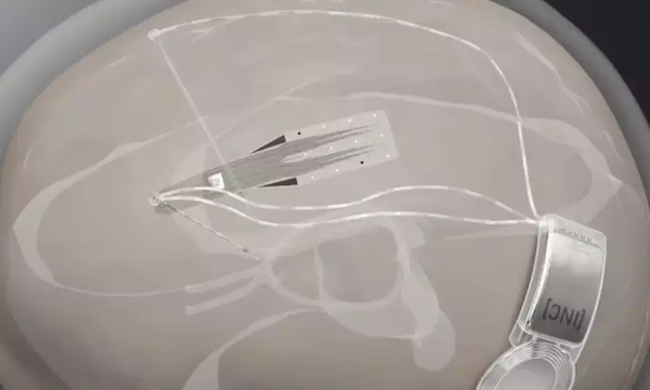 Scientists test graphene chip implant to revolutionize brain tumor surgery