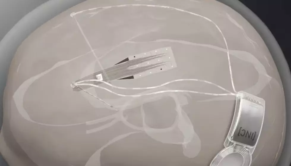 Scientists test graphene chip implant to revolutionize brain tumor surgery Scientists test graphene chip implant to revolutionize brain tumor surgery