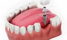Benefits and Insights of Dental Implants for a Confident Smile