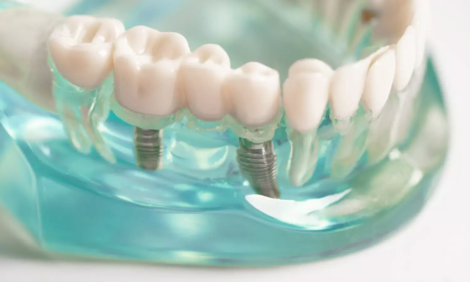 Why Dental Implants Are the Ultimate Choice for Missing Teeth