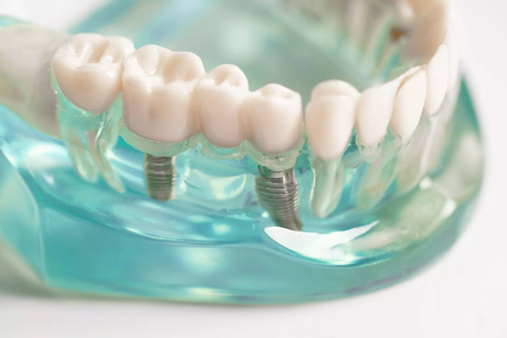 Why Dental Implants Are the Ultimate Choice for Missing Teeth Why Dental Implants Are the Ultimate Choice for Missing Teeth