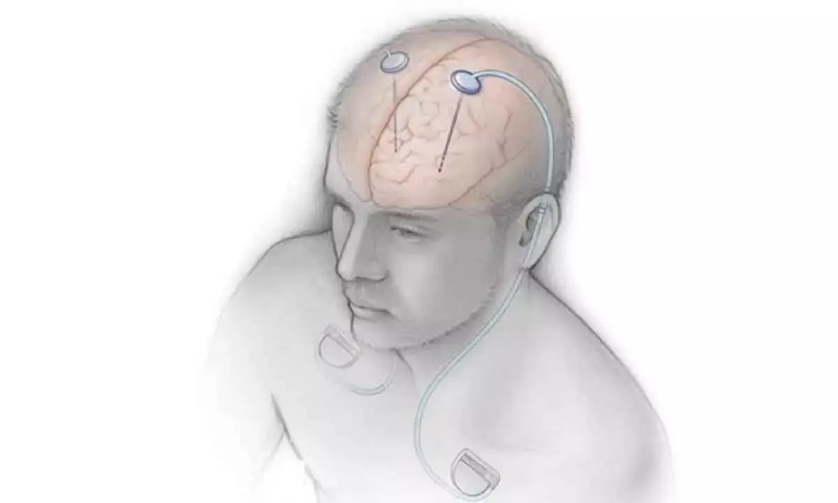 Indian Deep Brain Stimulator Market To Grow At 10% CAGR