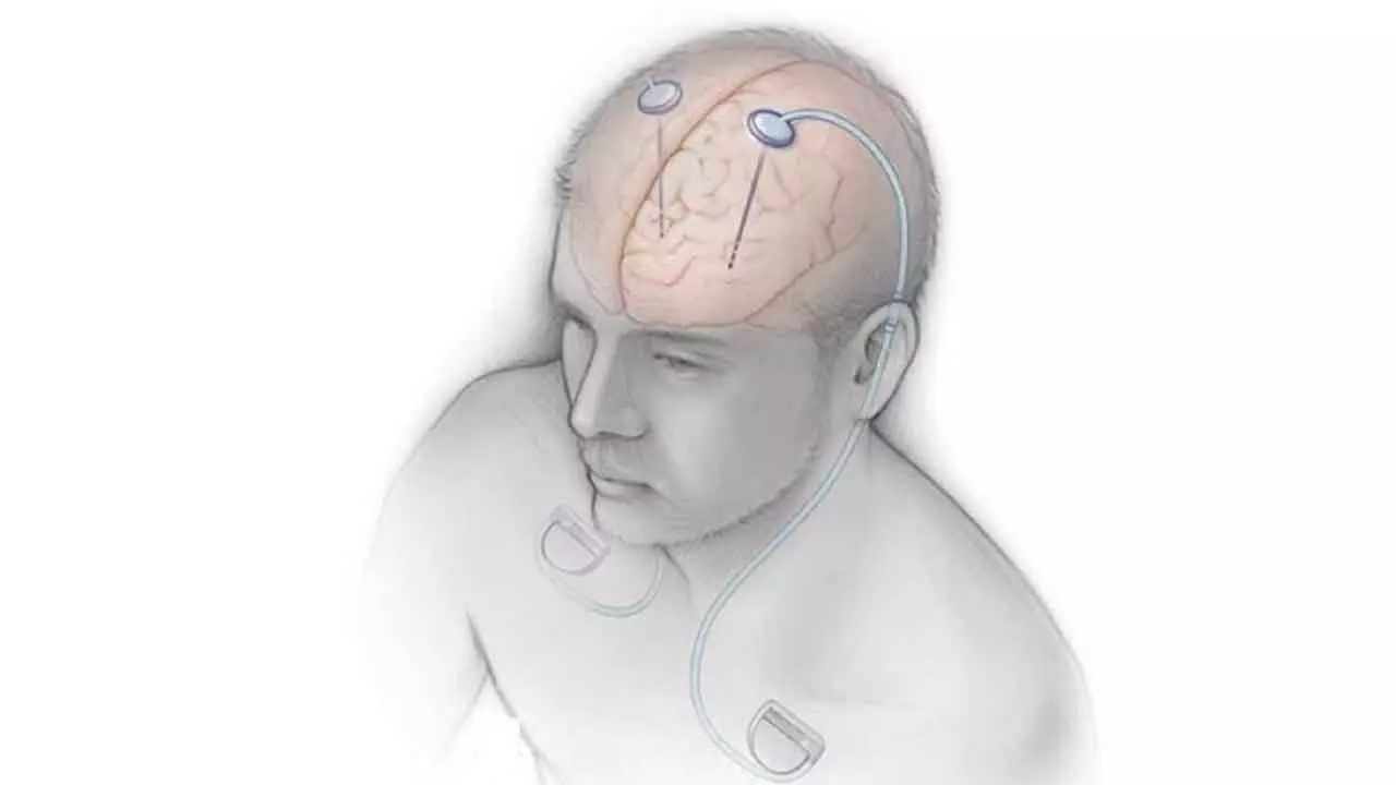Indian Deep Brain Stimulator Market To Grow At 10% CAGR Indian Deep Brain Stimulator Market To Grow At 10% CAGR