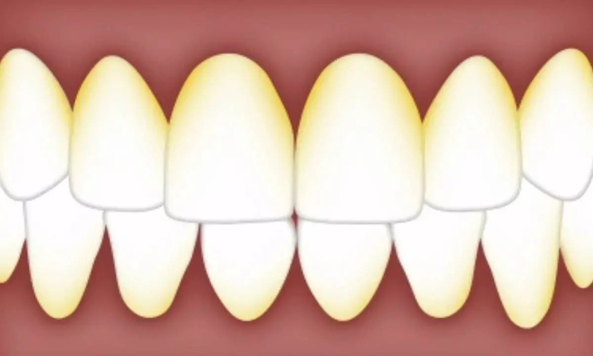 Measuring oral bacterial levels key to detect Alzheimer’s risk early: Study
