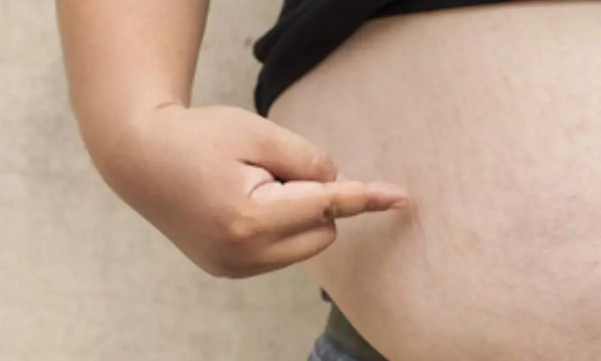 Over half of adults, third of children to become overweight or obese globally by 2050: Lancet