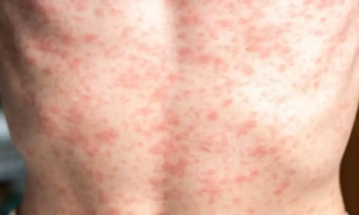 US reports over 300 measles cases in 2025