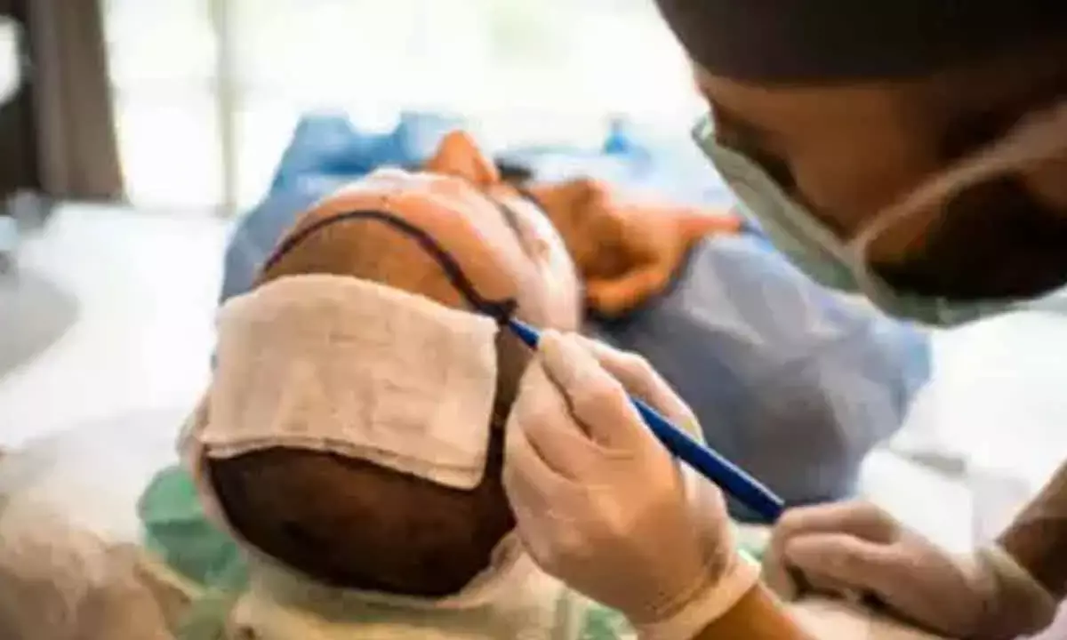 Indian Hair Transplant Industry Is Projected To Grow At A CAGR Of 17.12% By 2029