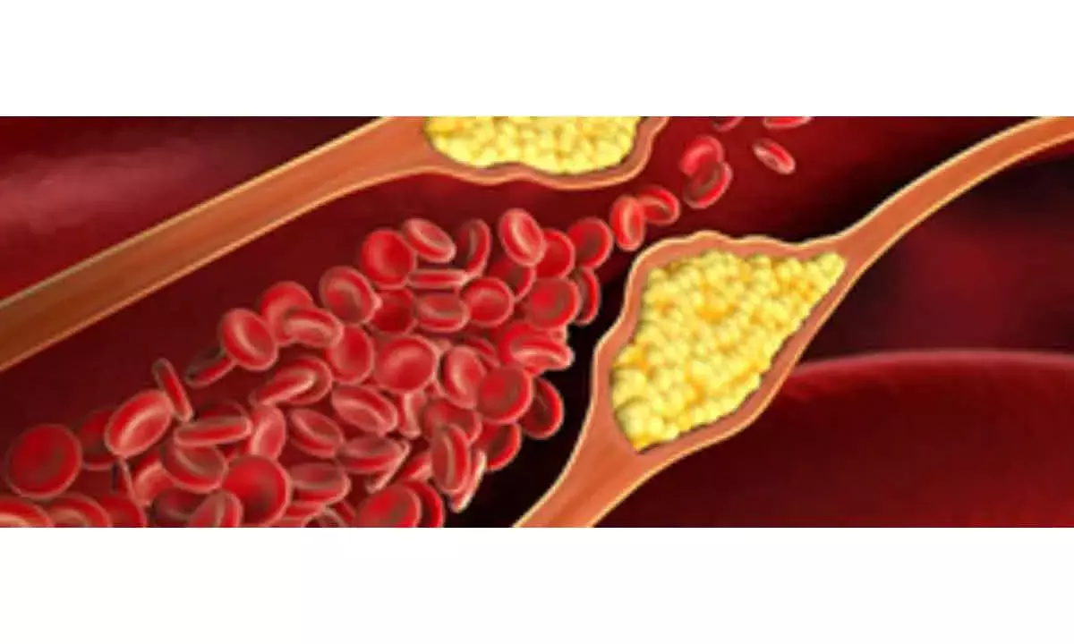 Reduce Bad Cholesterol Levels To Keep Alzheimer’s, Dementia At Bay