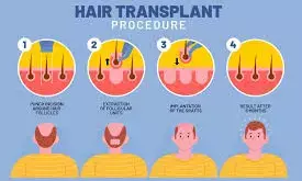 FUE vs FUT | Hair Transplant Shifting Towards Modern Technique: Assure Clinic