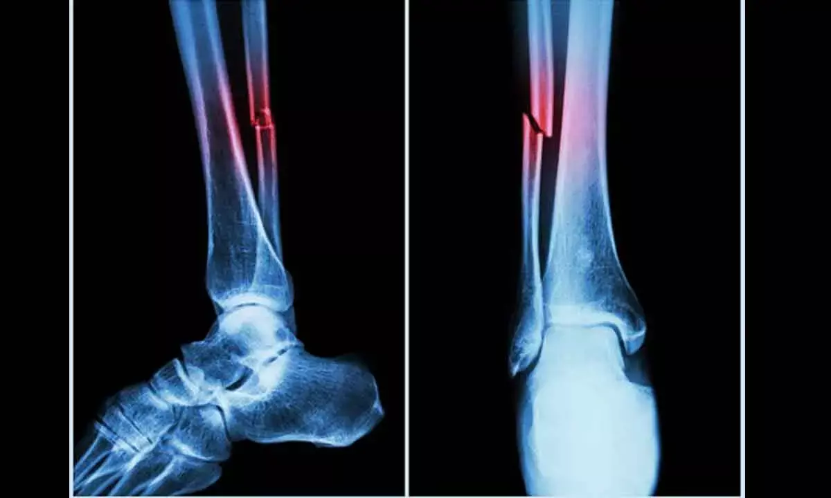 New Machine Algorithm Can Track Fracture Risks