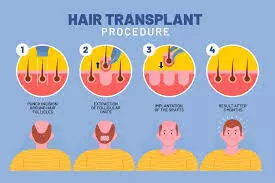 FUE vs FUT | Hair Transplant Shifting Towards Modern Technique: Assure Clinic