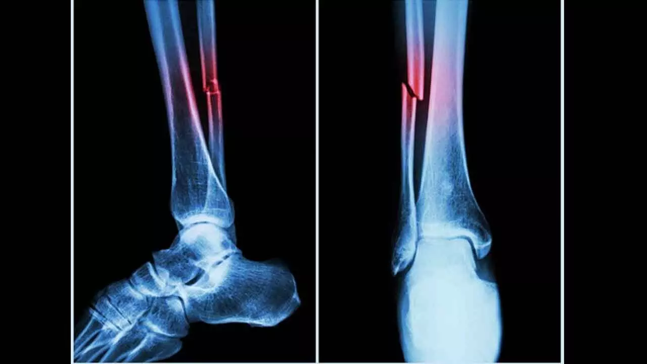 New Machine Algorithm Can Track Fracture Risks New Machine Algorithm Can Track Fracture Risks