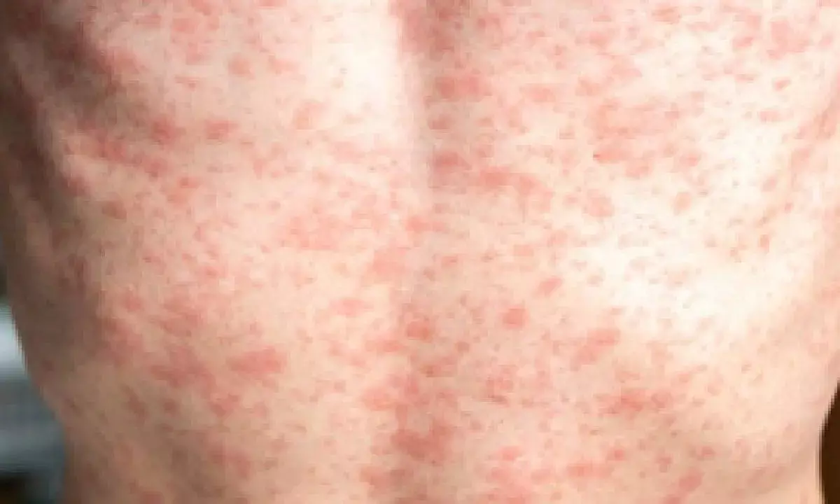 Over 900 measles cases reported in US so far in 2025: CDC